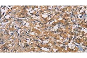 Immunohistochemistry of paraffin-embedded Human thyroid cancer tissue using PIKFYVE Polyclonal Antibody at dilution 1:50 (PIKFYVE antibody)