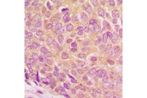 Immunohistochemical analysis of Ataxin 1 (pS775) staining in human breast cancer formalin fixed paraffin embedded tissue section.