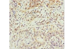 Immunohistochemistry of paraffin-embedded human bladder cancer using ABIN7144897 at dilution of 1:100