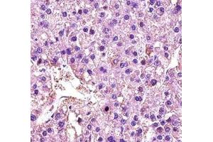 LDHA antibody immunohistochemistry analysis in formalin fixed and paraffin embedded human hepatocarcinoma (Lactate Dehydrogenase A antibody  (AA 204-232))