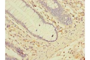 Immunohistochemistry of paraffin-embedded human colon cancer using ABIN7158150 at dilution of 1:100 (LRRC2 antibody  (AA 1-371))