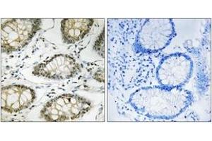 Immunohistochemistry analysis of paraffin-embedded human colon carcinoma, using ATR (Phospho-Ser428) Antibody. (ATR antibody  (pSer428))