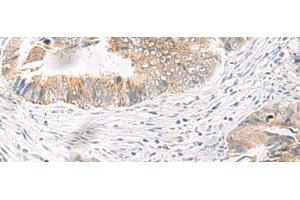 Immunohistochemistry of paraffin-embedded Human colorectal cancer tissue using IDUA Polyclonal Antibody at dilution of 1:35(x200) (IDUA antibody)
