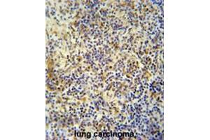 KRI1 antibody (N-term) immunohistochemistry analysis in formalin fixed and paraffin embedded human lung carcinoma followed by peroxidase conjugation of the secondary antibody and DAB staining. (KRI1 antibody  (N-Term))