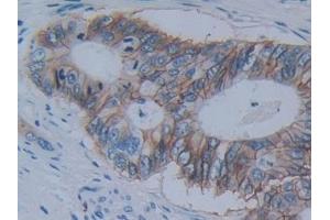 Detection of CDH17 in Human Colorectal cancer Tissue using Polyclonal Antibody to Cadherin 17 (CDH17) (LI Cadherin antibody  (AA 67-351))