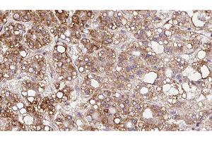 ABIN6279837 at 1/100 staining Human liver cancer tissue by IHC-P. (SLC6A20 antibody  (Internal Region))