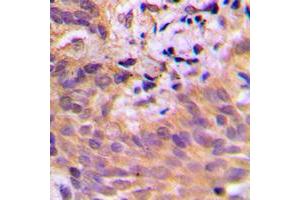 Immunohistochemical analysis of CDKL2 staining in human breast cancer formalin fixed paraffin embedded tissue section. (CDKL2 antibody  (Center))