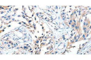Immunohistochemistry of paraffin-embedded Human esophagus cancer using AOX1 Polyclonal Antibody at dilution of 1:65 (AOX1 antibody)