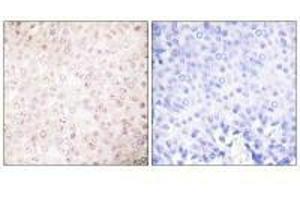 Immunohistochemical analysis of paraffin-embedded human breast carcinoma tissue using P300/CBP antibody. (EP3/CREBBP antibody)