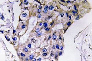 Immunohistochemistry (IHC) analyzes of IL-5 antibody in paraffin-embedded human breast carcinoma tissue. (IL-5 antibody)