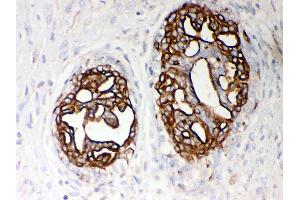 Anti- PKM2 Picoband antibody, IHC(P) IHC(P): Human Mammary Cancer Tissue (PKM antibody  (N-Term))