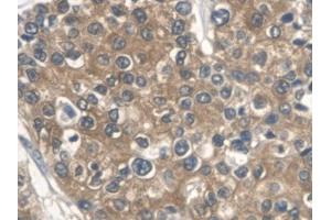 DAB staining on IHC-P; Samples: Human Prostate cancer Tissue (ALDOA antibody  (AA 18-273))