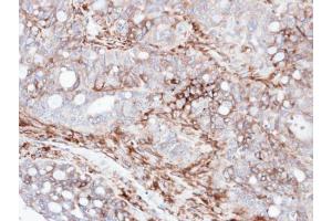 IHC-P Image Immunohistochemical analysis of paraffin-embedded human serous ovarian cancer, using AKAP12, antibody at 1:100 dilution.