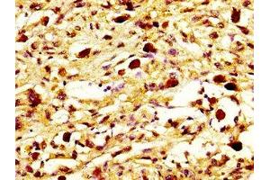 IHC image of ABIN7160588 diluted at 1:800 and staining in paraffin-embedded human melanoma performed on a Leica BondTM system. (MYH7 antibody  (AA 1802-1915))