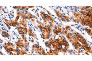 Immunohistochemistry of paraffin-embedded Human lung cancer tissue using SEPT4 Polyclonal Antibody at dilution 1:50 (Septin 4 antibody)