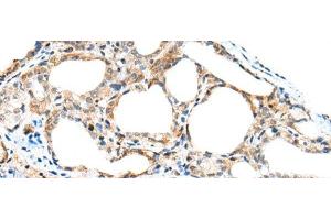 Immunohistochemistry of paraffin-embedded Human thyroid cancer tissue using SPACA3 Polyclonal Antibody at dilution of 1:45(x200)