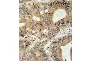 ABCC3 antibody (Center) (ABIN654103 and ABIN2843987) immunohistochemistry analysis in formalin fixed and paraffin embedded human colon carcinoma followed by peroxidase conjugation of the secondary antibody and DAB staining. (ABCC3 antibody  (AA 899-925))