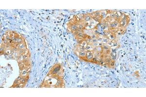 Immunohistochemistry of paraffin-embedded Human cervical cancer using ANXA3 Polyclonal Antibody at dilution of 1:35 (Annexin A3 antibody)