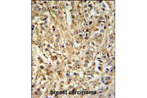DDX6 Antibody IHC analysis in formalin fixed and paraffin embedded breast carcinoma followed by peroxidase conjugation of the secondary antibody and DAB staining. (DDX6 antibody  (AA 348-375))