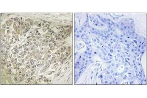 Immunohistochemistry analysis of paraffin-embedded human breast carcinoma tissue, using p70 S6 Kinase (Ab-424) Antibody. (RPS6KB1 antibody  (AA 414-463))