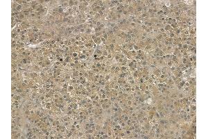 ABIN6258063 and ABIN6274646 at 1/100 staining human hepatocellular carcinoma by IHC-P.