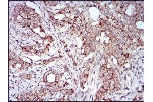 Immunohistochemical analysis of paraffin-embedded human cervical cancer tissues using GAB2 mouse mAb with DAB staining. (GAB2 antibody  (AA 332-476))