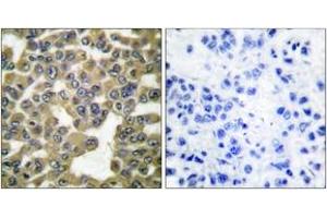 Immunohistochemistry analysis of paraffin-embedded human breast carcinoma tissue, using MMP-13 Antibody. (MMP13 antibody  (AA 10-59))