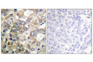 Immunohistochemistry (IHC) image for anti-Mucin 1 (MUC1) (pTyr1229) antibody (ABIN1847433) (MUC1 antibody  (pTyr1229))