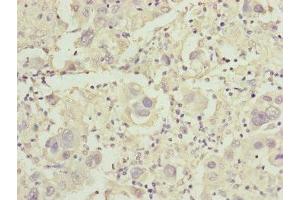 Immunohistochemistry of paraffin-embedded human liver cancer using ABIN7149016 at dilution of 1:100 (CDO1 antibody  (AA 1-200))