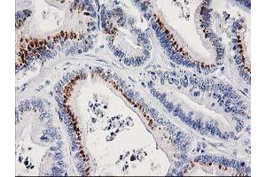 Immunohistochemical staining of paraffin-embedded Adenocarcinoma of Human colon tissue using anti-FGFR2 mouse monoclonal antibody.