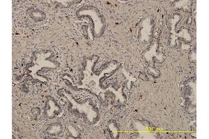 Immunoperoxidase of monoclonal antibody to EML4 on formalin-fixed paraffin-embedded human prostate cancer. (EML4 antibody  (AA 1-62))