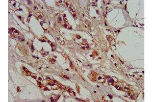 IHC image of ABIN7142146 diluted at 1:400 and staining in paraffin-embedded human breast cancer performed on a Leica BondTM system. (ADO antibody  (AA 137-270))