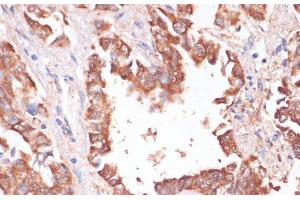 Immunohistochemistry of paraffin-embedded Human lung cancer using KCNH2 Polyclonal Antibody at dilution of 1:100 (40x lens). (KCNH2 antibody)