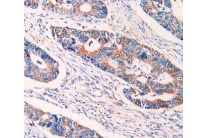 IHC-P analysis of rectum cancer tissue, with DAB staining.