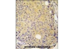 Forlin-fixed and paraffin-embedded hun prostata carcino tissue reacted with P3K5 ANtibody  g , which was peroxidase-conjugated to the secondary antibody, followed by DAB staining. (ASK1 antibody  (AA 821-849))
