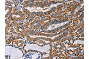 The image on the left is immunohistochemistry of paraffin-embedded Human thyroid cancer tissue using ABIN7128293(AGPAT4 Antibody) at dilution 1/25, on the right is treated with fusion protein. (AGPAT4 antibody)