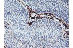 Immunohistochemical staining of paraffin-embedded Carcinoma of Human bladder tissue using anti-IGJ mouse monoclonal antibody.