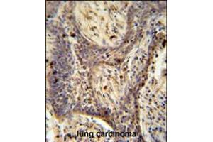 PPRC1 antibody immunohistochemistry analysis in formalin fixed and paraffin embedded human lung carcinoma followed by peroxidase conjugation of the secondary antibody and DAB staining.