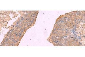 Immunohistochemistry of paraffin-embedded Human liver cancer tissue using NIPSNAP1 Polyclonal Antibody at dilution of 1:50(x200) (NIPSNAP1 antibody)