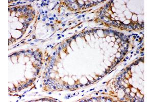 Anti- BAK Picoband antibody, IHC(P) IHC(P): Human Intestinal Cancer Tissue