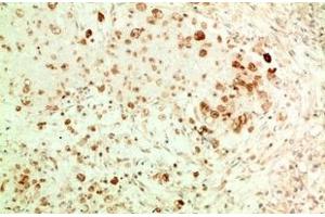 Immunohistochemistry of paraffin-embedded Human ovarian carcinoma tissue using ATG5 Monoclonal Antibody at dilution of 1:200. (ATG5 antibody)