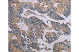 Immunohistochemistry of Human colon cancer using MMP20 Polyclonal Antibody at dilution of 1:40 (MMP20 antibody)