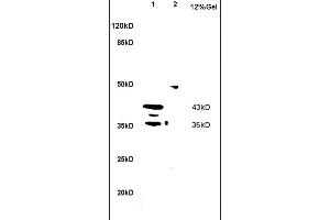 Formalin-fixed and paraffin embedded human cervical carcinoma labeled with Anti MIIP Polyclonal Antibody, Unconjugated (ABIN758681) at 1:200 followed by conjugation to the secondary antibody and DAB staining (MIIP antibody  (AA 251-350))