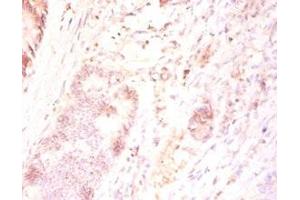Immunohistochemistry of paraffin-embedded human colon cancer using ABIN7165346 at dilution of 1:50 (TMEM185B antibody  (AA 1-370))