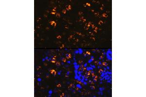Immunofluorescence analysis of human lung cancer cells using NAPSA Rabbit pAb (ABIN6128367, ABIN6144368, ABIN6144369 and ABIN6221232) at dilution of 1:100 (40x lens). (NAPSA antibody  (AA 25-250))