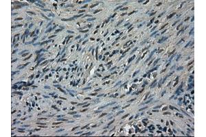 Immunohistochemical staining of paraffin-embedded Carcinoma of kidney tissue using anti-TRIB2mouse monoclonal antibody. (TRIB2 antibody)