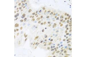 Immunohistochemistry of paraffin-embedded human lung cancer using ZBTB17 antibody (ABIN6133380, ABIN6150370, ABIN6150371 and ABIN6224531) at dilution of 1:100 (40x lens). (ZBTB17 antibody  (AA 121-360))