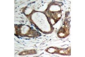 Immunohistochemical analysis of Plakophilin 2 staining in human prostate cancer formalin fixed paraffin embedded tissue section.
