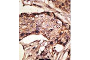 Formalin-fixed and paraffin-embedded human cancer tissue reacted with the primary antibody, which was peroxidase-conjugated to the secondary antibody, followed by AEC staining. (SIGLEC9 antibody  (C-Term))