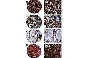 Immunohistochemisty of PTPN13 in formalin-fixed, paraffin embedded ovarian carcinoma cores from a tissue microarray. (PTPN13 antibody)